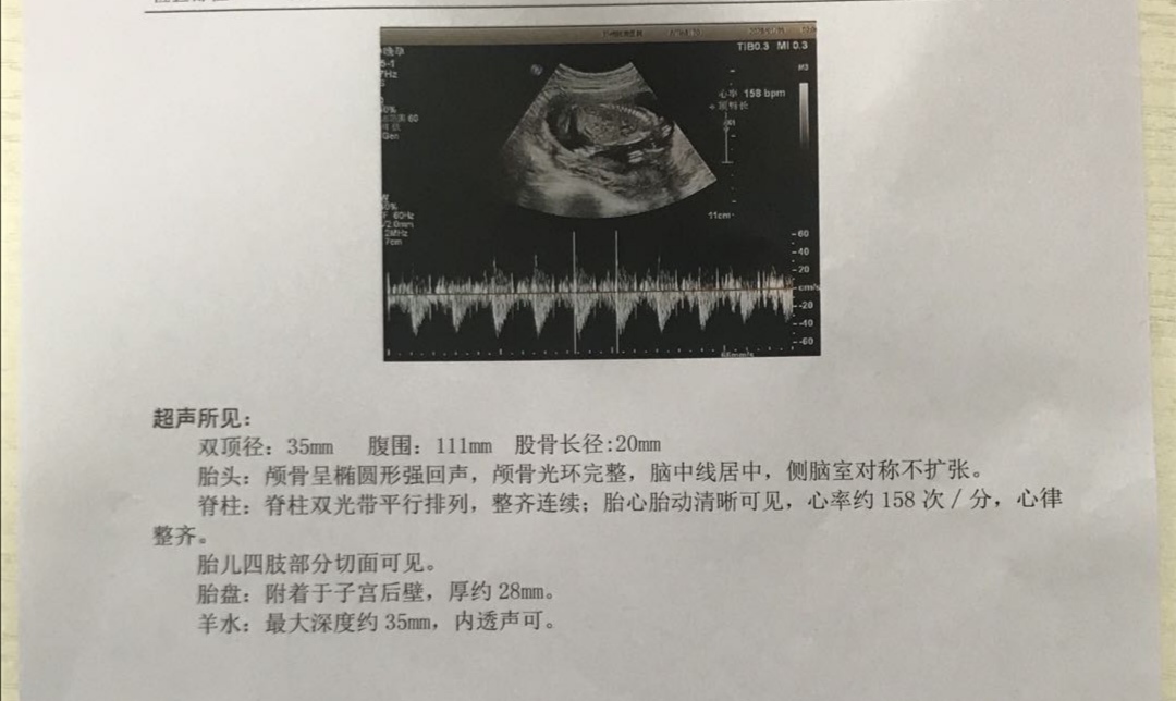 四维超声和二维b超的区别,产检b超比前两次小