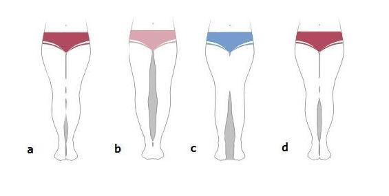 得了梨状肌怎么锻炼,得了梨状肌综合征需要注意什么