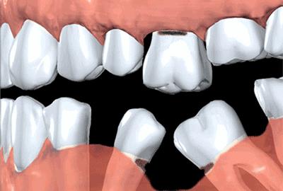 最里面烂牙残根不拔的危害大吗,成人烂牙残根不拔的危害大吗