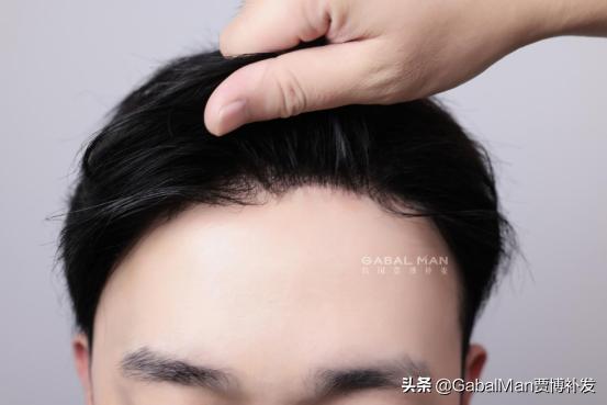 脱发不生发与身体有原因吗,脱发为什么不愿意理光头