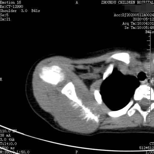 家长要警惕孩子腺样体面容,家长应该警惕孩子出现异常