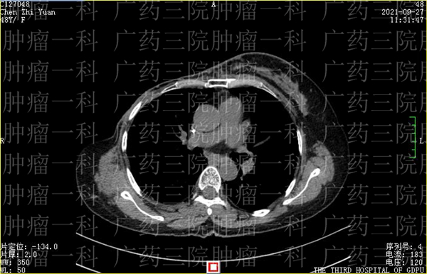 乳腺癌陈女士近况,广药三院癌症怎么转移
