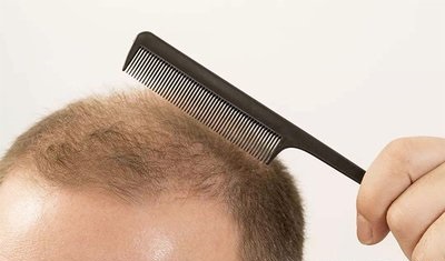 青少年脱发防脱小窍门,青少年如何预防脱发掉发