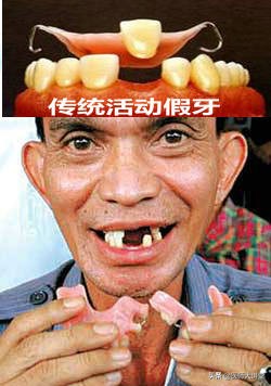 金属假牙托牙制作全过程,自己在家做树脂假牙新技术