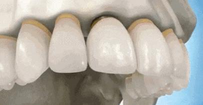 缺牙太久邻牙倾斜可以磨掉吗,缺牙太久导致旁边的牙倾斜了