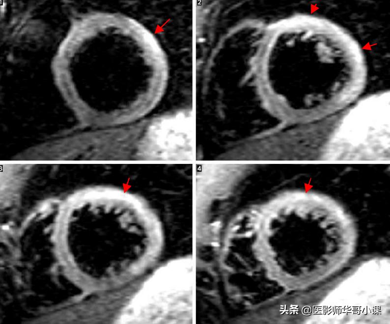 心脏mr增强扫描讲解,磁共振心脏扫描标准切面