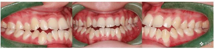 矫正后两年反弹会越来越严重吗,矫正完成两年牙齿还是松动