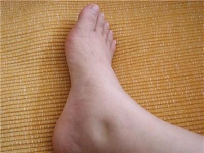 脚肿要警惕四种病手突出一块,脚肿要警惕四种病可以用醋擦吗