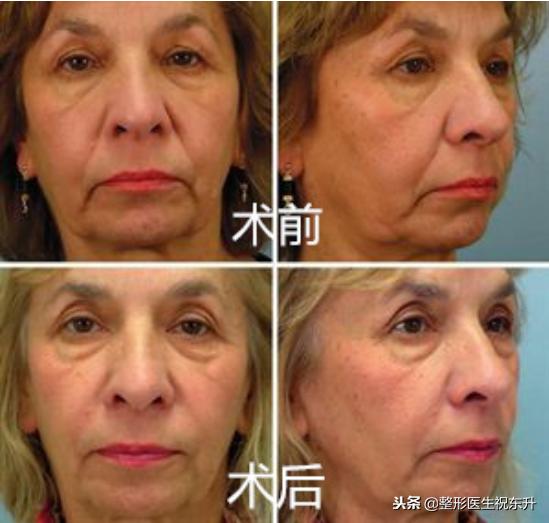 面部悬吊提升术的后遗症有哪些,面部悬吊提升术对比图
