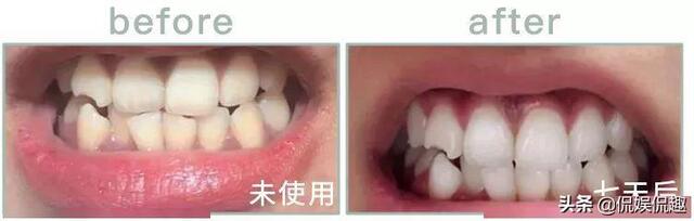 刷牙时一个小窍门彻底告别黄臭牙,刷牙的时候放点小苏打牙会变白吗