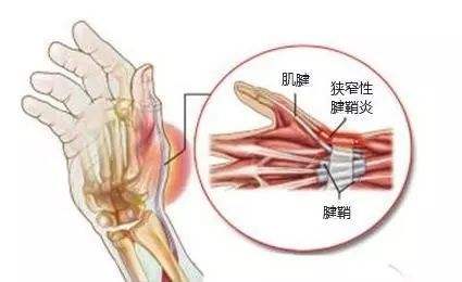 医生，我的手指为什么伸不直了