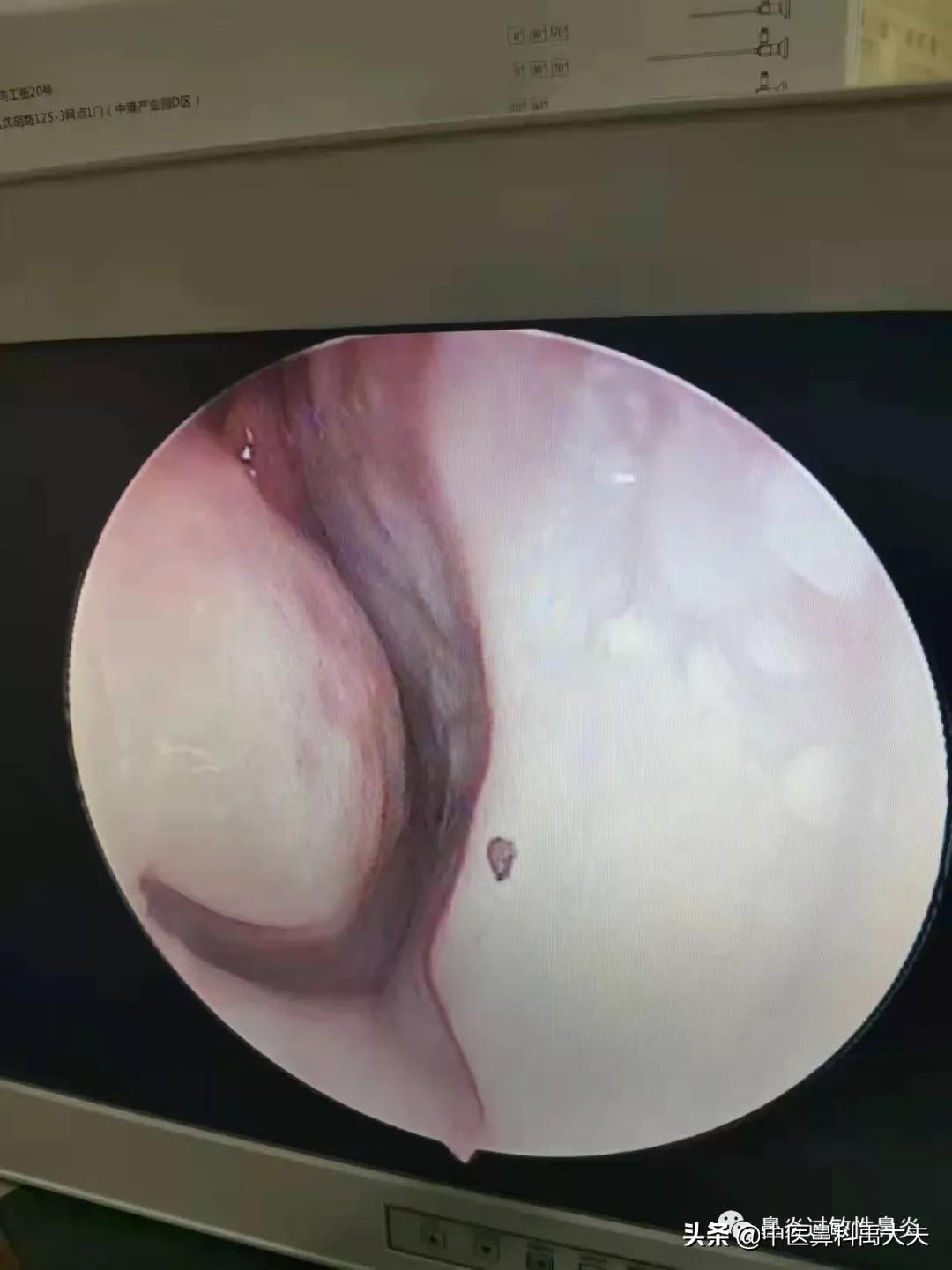 血管运动性鼻炎和过敏性鼻炎症状,鼻炎和过敏性鼻炎症状区别