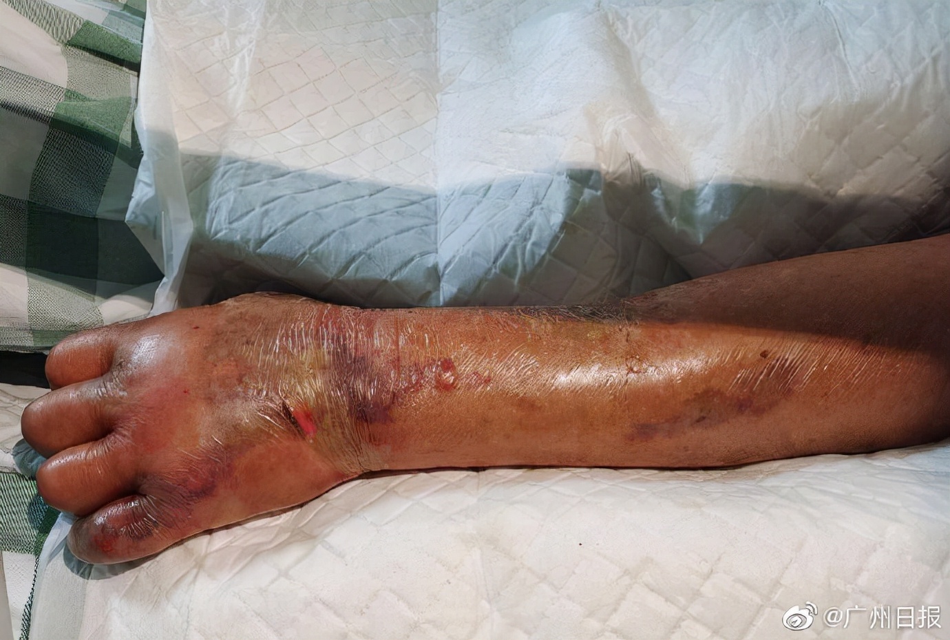 洗虾的时候被扎伤了,洗虾被扎手多大概率死亡