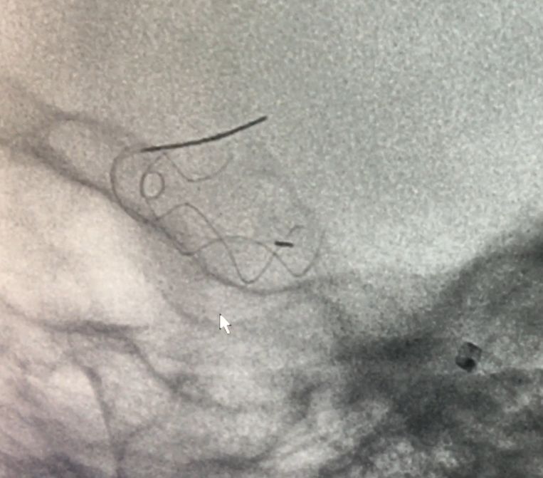 Tubridge®治疗多发性动脉瘤