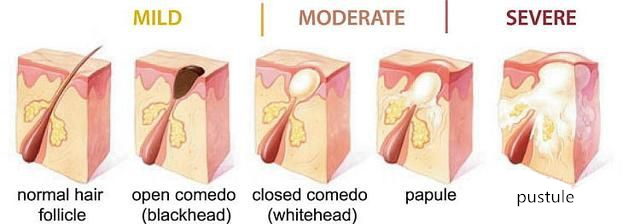 夏天来了祛痘痘,夏天来了长痘痘了怎么办