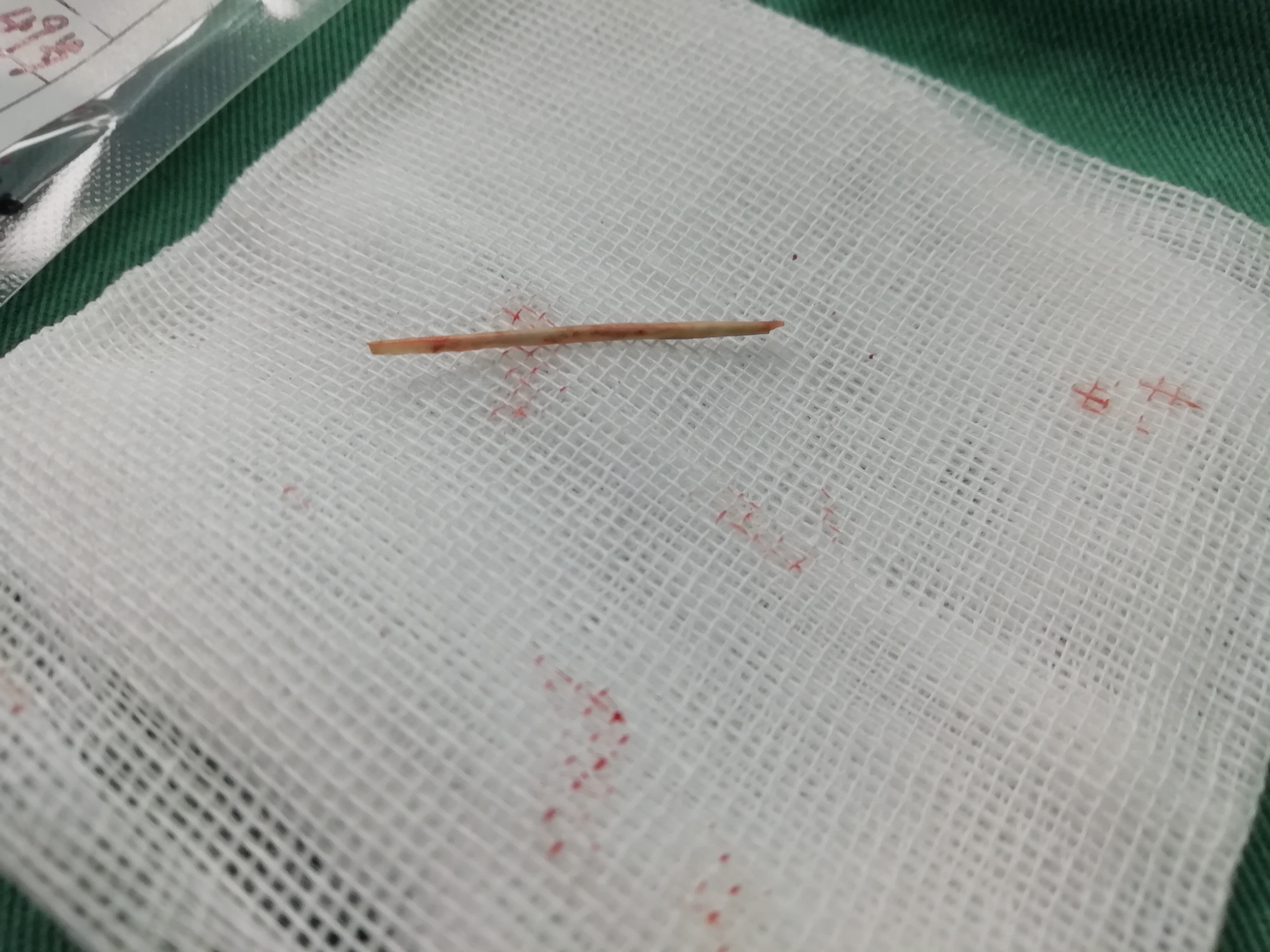 屁屁痛很像肌肉拉伤,屁屁痛肚子痛是什么原因