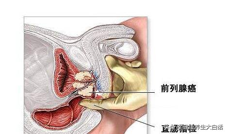 肛门坠胀怎么治疗和调理,肛门坠胀怎么治疗最好