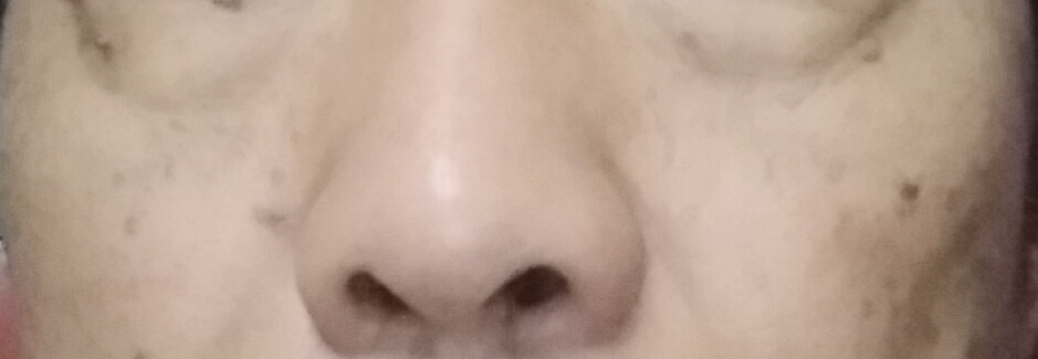 脸上被太阳晒的黑斑怎么去除,脸上长黑斑怎么去除最快方法