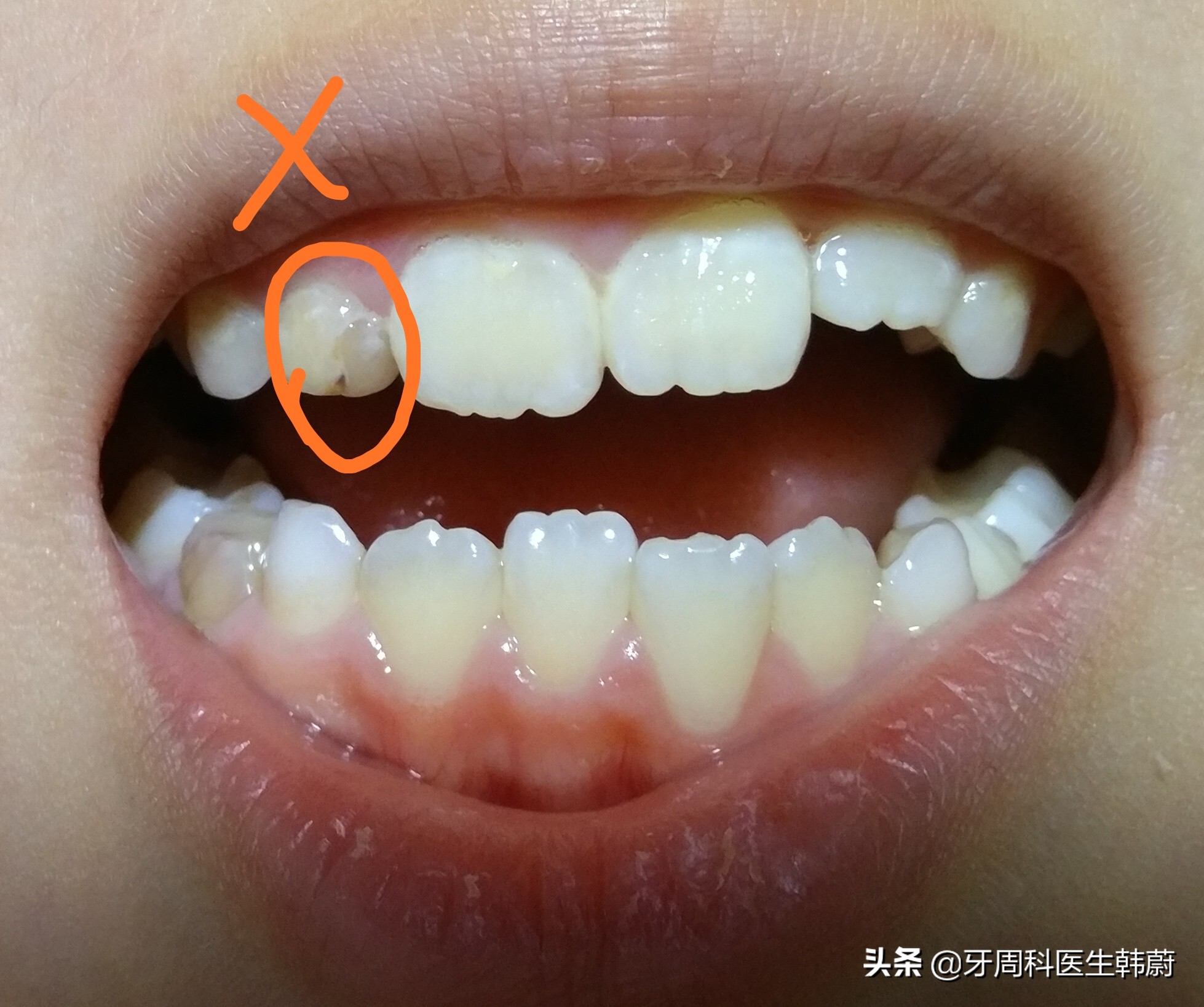 宝宝长双层牙乳牙怎么拔掉,6岁小孩长双层牙必须拔掉吗