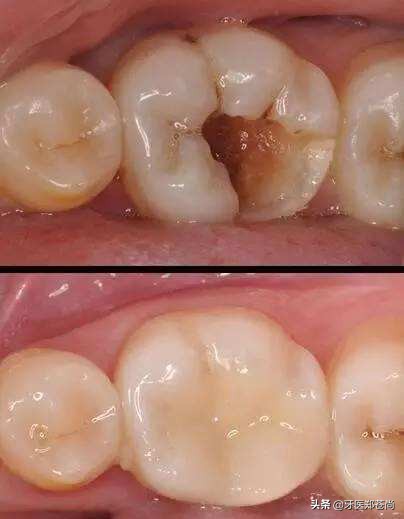 蛀牙很深但是不痛需要根管治疗吗,蛀牙根管治疗是什么样的
