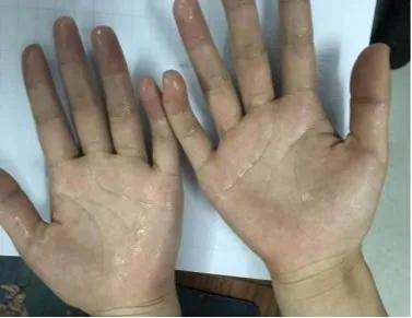 医院怎么确诊手汗症,广西手汗症治疗