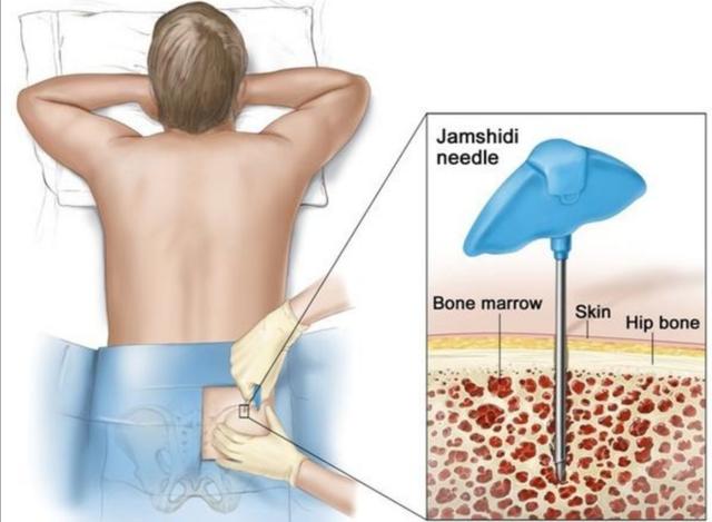 骨穿和骨髓穿刺区别,骨穿痛还是无痛针痛