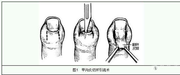 一文解答：甲沟炎的诊断方法和检查项目都有哪些？
