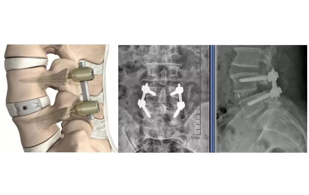 正美体态改善扁头是真的吗,成年人脊柱侧弯能恢复正常体态吗