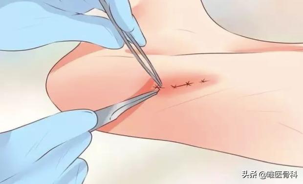 足底筋膜炎跑步脚后跟疼怎么办,走路脚跟痛当心足底筋膜炎