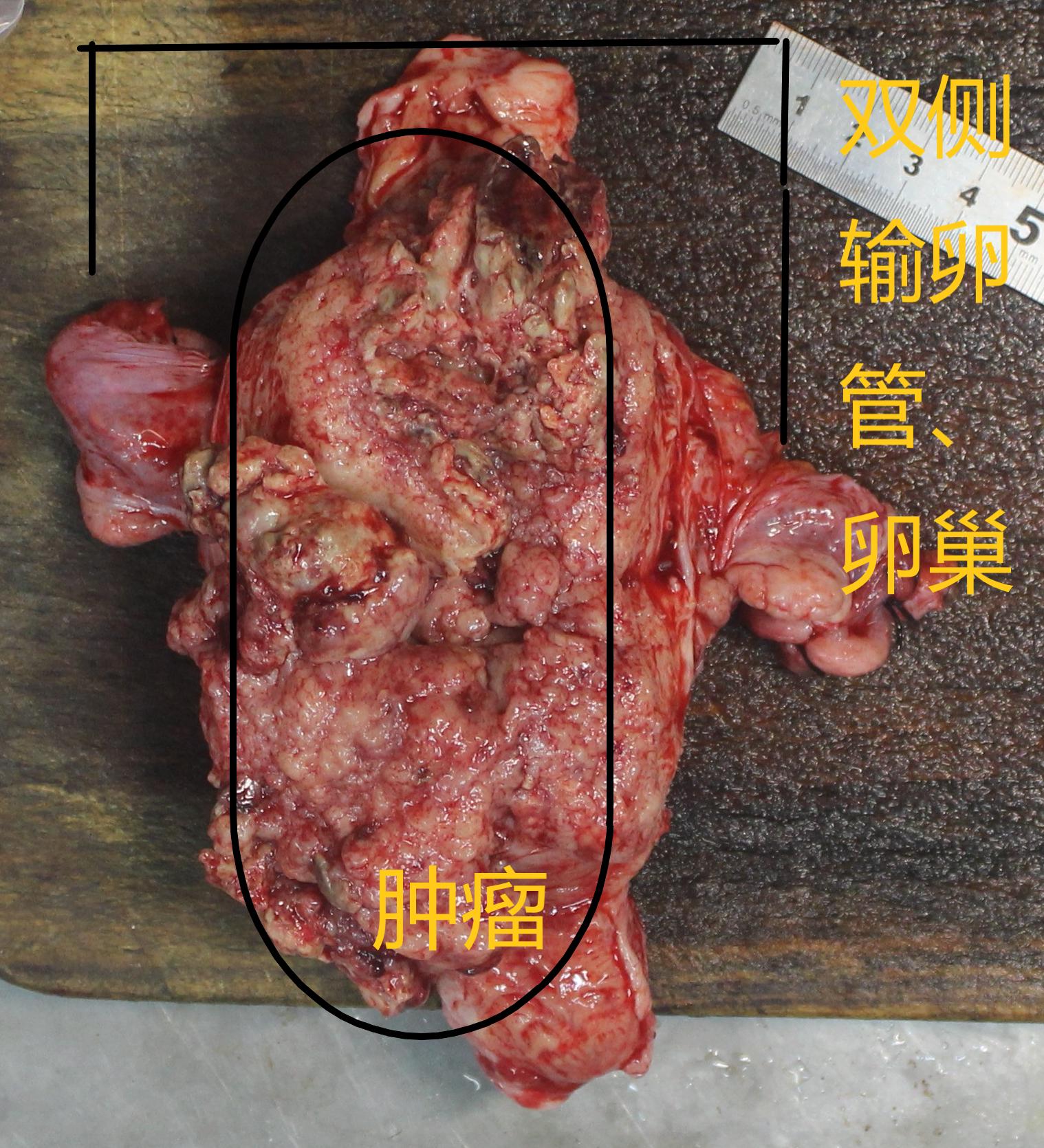 子宫内膜癌都会有阴道出血症状吗,子宫内膜癌阴道排液是什么症状