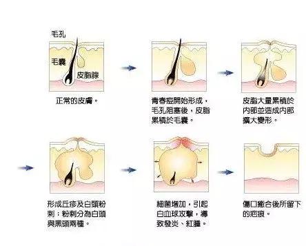 脸部刮痧后长痘痘发痒,手上长痘痘发痒怎么办