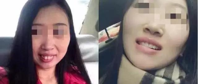 龅牙牙齿矫正的最佳方法,龅牙凸嘴露龈笑