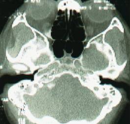 慢性鼻窦炎药物治疗原则,慢性鼻窦炎初步诊疗措施