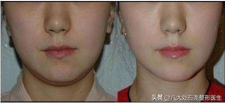 下巴脂肪堆积的解决方法,下巴脂肪过多怎么办
