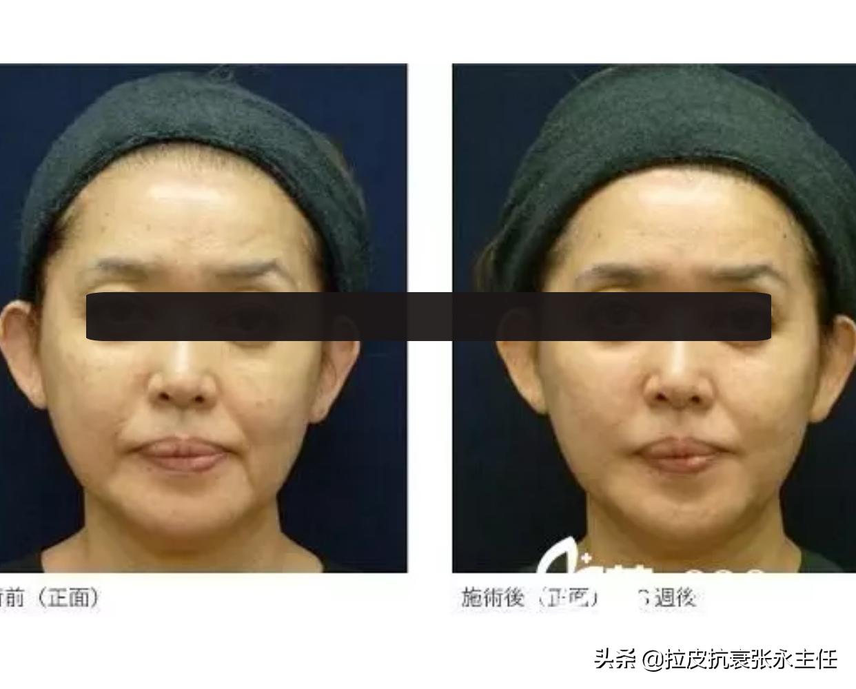 面部拉皮除皱整形多少钱一次,面部除皱拉皮手术价格是多少