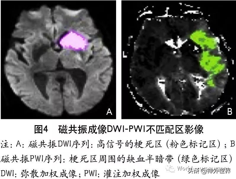 急性缺血性卒中诊治指南2023,缺血性卒中介入指南