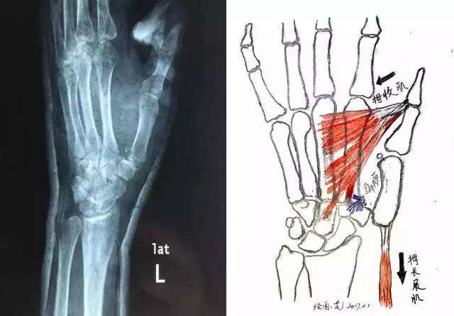 鎵嬮儴涓灑绁炵粡鍙楁崯浼氬紩璧锋墜楹诲悧,鎵嬮儴绁炵粡鍙楁崯鎵嬮夯鎬庝箞鍥炰簨