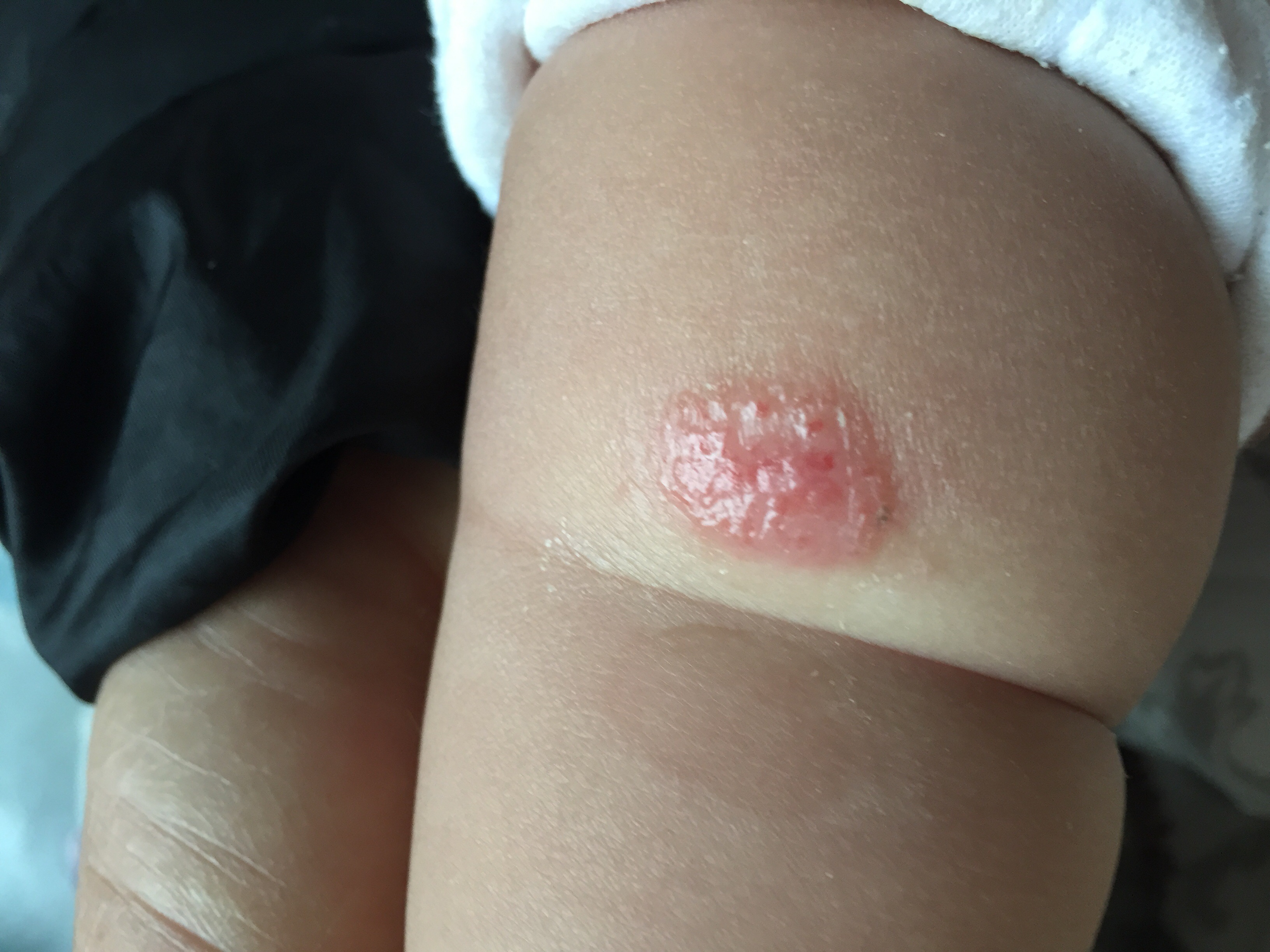 湿疹似乎是一种治不好的病,湿疹和痒疹是同一种病吗