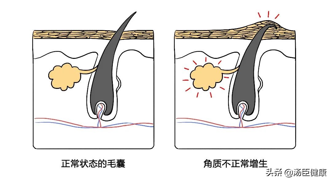得了系统性红斑狼疮男朋友说分手,男生长了鸡皮肤