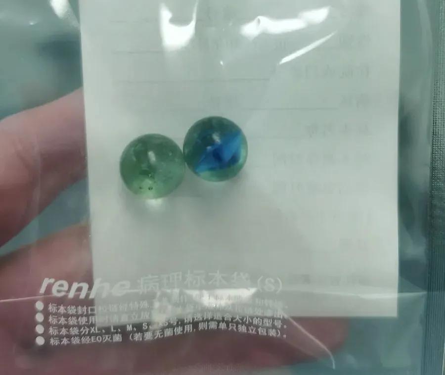 四岁孩子耳朵里塞进钢珠,小男孩往泥巴里塞6个钢珠