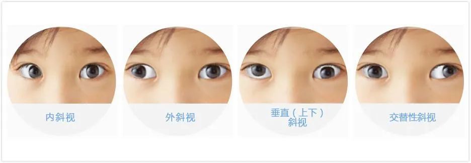 孩子总是侧头看东西?斜视治疗不及时可能失去视功能