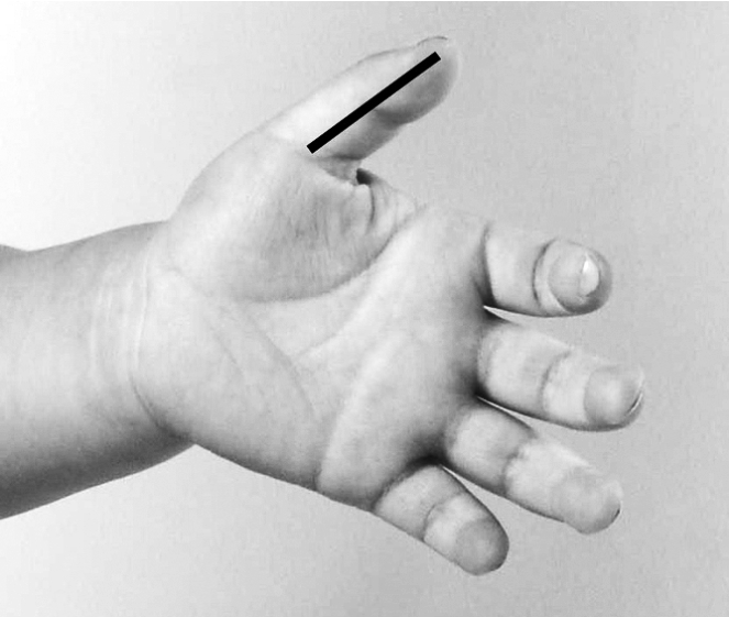 儿童感冒反复发烧怎么降烧,小孩反复发烧物理降温的正确方法