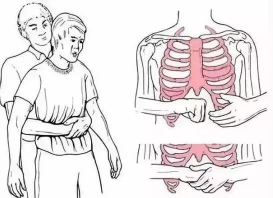 呼吸道堵塞海姆立克急救法,呼吸道吸入异物海姆立克急救法