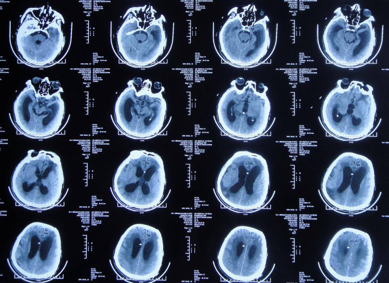 颅脑外伤术后脑积水,脑外伤脑积水颅骨缺失