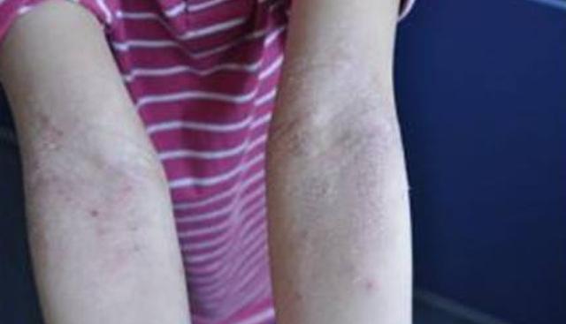 湿疹过来人的独家秘籍,湿疹患者的自救战