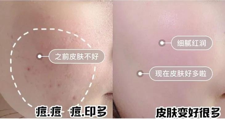 专治螨虫的洗面奶,螨虫专用洁面乳