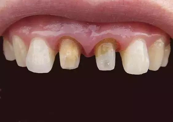 不含重金属的烤瓷牙有吗,诊所100元一颗的烤瓷牙有毒吗