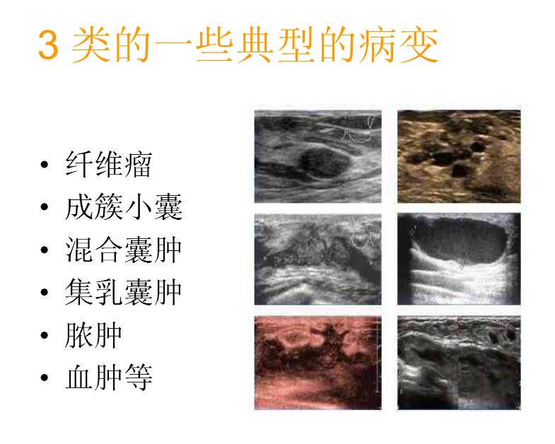 乳腺bi-rads分类有哪些,乳腺bi-rads的分类