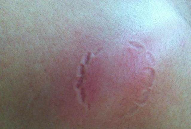 打了乙肝疫苗被狗咬了,乙肝患者被狗咬了打狂犬针有用吗