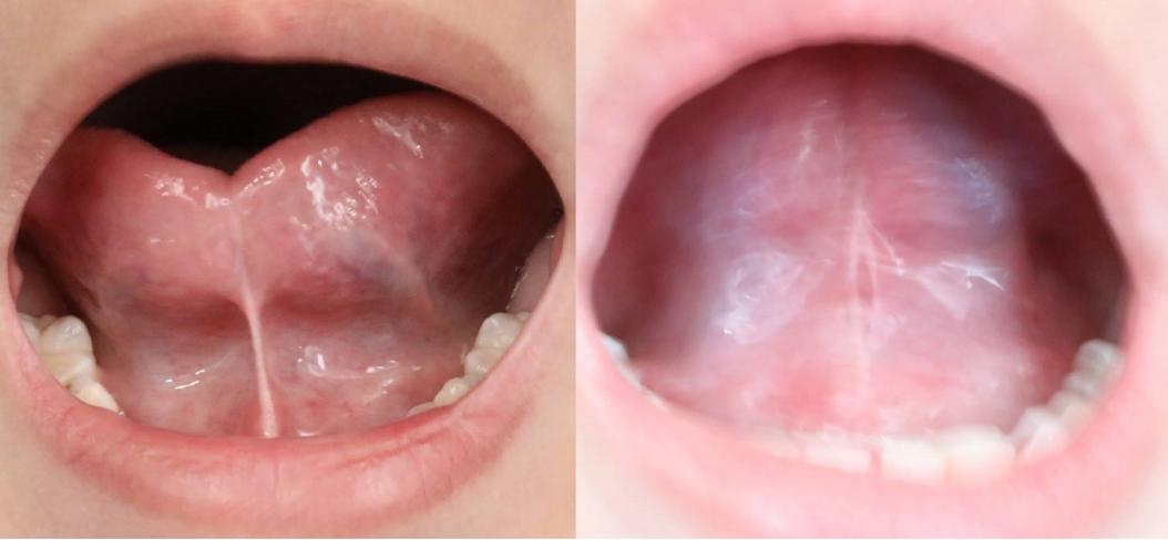 两岁半宝宝舌系带短必须手术吗,舌系带短两边还连着手术几天能好